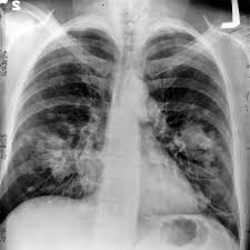  Akciğer kanserine dikkat